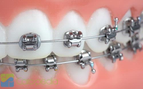 Cara menjaga kesehatan gigi bagi pengguna behel gigi atau kawat gigi