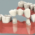 Lansia Kurang Sadar Pentingnya Gigi Palsu