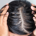 5 Cara Mengobati dan Mencegah Rambut Berminyak