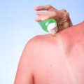 Berapa Lama Sunburn Berlangsung  Berikut Tips Cepat Menyembuhkannya?