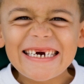 Penanganan Segera Masalah Gigi Patah, Tanggal dan Berlubang pada Anak
