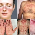 Terungkap, Penyebab Spesifik Penyakit Lupus