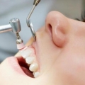 Perlunya Memeriksakan Gigi Minimal 6 Bulan Sekali