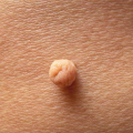 Cara Aman Menghilangkan Skin Tag Menurut Dokter Kulit
