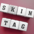 Kenali soal Skin Tag: Penyebab, Cara Mencegah dan Mengobati